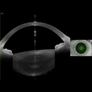 The high-resolution imaging on the Metrics App allowed us to view the LASIK flap in this patient after 3 years of surgery.
.
Image Courtesy: Dr. Vinay Murthy
Prabha Eye Hospital, 
Bengaluru.