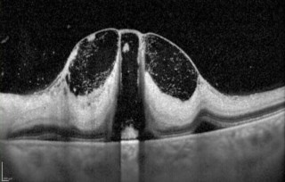 Case of CRAO post snake bite with hyperrelectivity in inner and outer retina seen in OCT .
Dr.GAYATHRI M S
