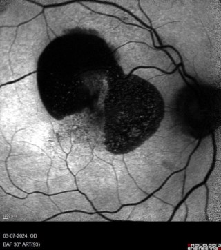 Prolyp with sub-retinal breakthrough bleeding.
Dr.Susmita Saha
Aditya Birla Sankara Nethralaya
