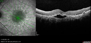 POLYPOIDAL CHOROIDAL VASCULOPATHY
Dr. SATHYAN P
