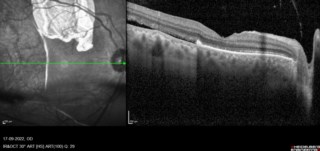 RPE R.I.P – Multimodal imaging on Spectralis revealed a giant RPE rip. FFA showed a window defect with hypoautofluorescent margins indicating scrolled RPE. FAF confirmed the pattern, and OCT revealed the large RPE tear.
Dr. Karishma Tendulkar