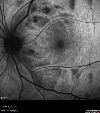 Purtscher retinopathy.
Dr. Susmita Saha
Aditya Birla Sankara Nethralaya
