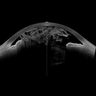 Anterion Imaging revealed ruptured anterior capsule and intact posterior capsule in a case of traumatic cataract with corneal perforation—missed on slit-lamp.
Image Courtesy : Dr. Sanjay Chaudhary, Eye 7, New Delhi.