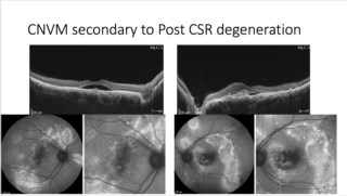 Autofluorescence detects RPE damage in CSR and helps monitor CNVM progression. Fluorescein Angiography shows abnormal vessels, guiding laser or anti-VEGF treatment for post-CSR CNVM management.
Dr. Ashraya Nayaka, The Eye Foundation, Coimbatore