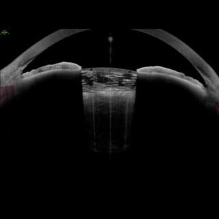 The high quality of imaging afforded by the Anterion enabled this clear visualisation of the Intumescent Cataract.
.
Image Courtesy: Dr. Rohit Om Prakash,
Om Prakash Eye Institute,
Amritsar.