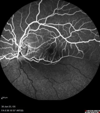 Fundus Fluorescein Angiogram Image of BRAO
Mr. Sayantan Sengupta
Sankara Nethralaya kolkata
