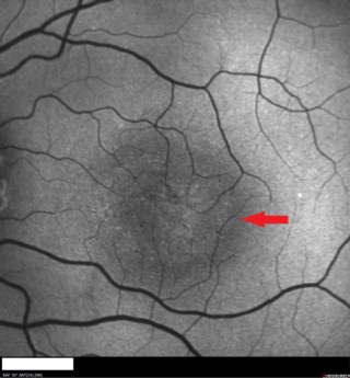 MacTel type 2 shows Müller cell dysfunction with outer retinal hyporeflective spaces on OCT. Early inner lamellar holes and late RPE hyperplasia with SNV lead to vision loss.
Mr. Pawan Kumar
