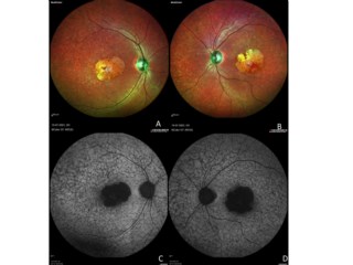 Fundus photos show “beaten-bronze” macular atrophy with yellowish flecks in both eyes. FAF reveals central hypoautofluorescence and multiple flecks, characteristic of Stargardt disease.
Dr. Shivani Chhabra, EYE7 Hospital, New Delhi.
