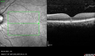 Early Detection of solar retinopathy in HRA
Mr. TAPOJJWAL PAL

