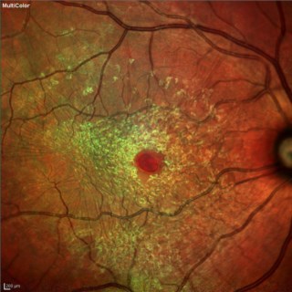 Case of Epiretinal Membrane with Lamellar Macularhole seen in multi modal reflectance.
Dr. GAYATHRI M S
