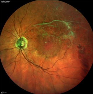  Case of old STBRVO with ghost vessels seen in multi modal reflectance.
Dr.GAYATHRI M S
