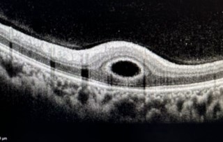 OCT shows fast intraretinal fluid progression in a 21-year-old girl with Optic disc pit, diagnosed as ‘Karnenburg syndrome bei grubenpapille’. The scan captures a ‘button hole’ pattern of schisis before SRF accumulation.
Dr. Pawan Malhotra, SGHS Hosp