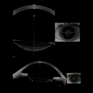 Anterion images of Late Capsular Bag Distension Syndrome:
Image 1: fluid behind IOL’s posterior surface with PCO
Image 2: post-ND YAG capsulotomy showing whirling of posterior capsule.
Image Courtesy: Dr. Pooja Khamar, Narayana Nethralaya,