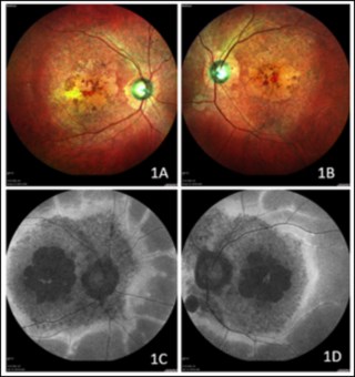 FAF in Stargardt’s shows central hypoautofluorescence (macular RPE loss), surrounding flecks with variable autofluorescence, and a rare outer rim of hyperautofluorescence around vessels—possibly from altered lipofuscin or RPE function. 
Dr. Ashish
