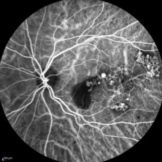 ICGA showing multiple polyps with branching vascular networks in a case of Polypoidal Choroidal Vasculopathy.
Mrs. GOURI DAS
