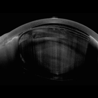 This is the image of an anteriorly dislocated Cataractous Lens post blunt trauma.
.
Image Courtesy: Dr. Pooja Khamar,
Narayana Nethralaya, 
Bengaluru.