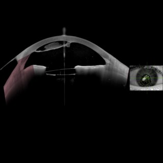 In the above image a blob of vitreous is seen engulfed in the cornea -possibly an eventful cataract surgery.
.
Image Courtesy: Dr. Deepti Kulkarni,
Dr. Anil Kulkarni Eye Hospital,
Miraj.