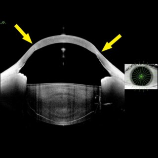 Anterion image shows a clear graft post-penetrating keratoplasty with no haze or rejection; cortical cataract envelops the crystalline lens.
Image Courtesy: Dr. Shivani Patnaik, Doctor Eye Institute, Mumbai.
