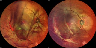 MCI on Spectralis revealed multiple choroidal ruptures and a retinal tear in a trauma patient with hazy media due to vitreous hemorrhage. Barrage laser was done to prevent macular detachment. Follow-up MCI showed clearer findings.
Dr. Karishma Tendul