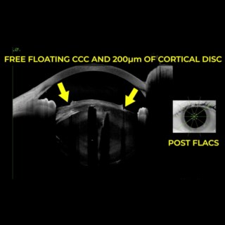 First-of-its-kind Anterion image captured post-femtolaser, pre-phacoemulsification, showing fragmented cataractous lens, free-floating capsule, and 200 microns of cortical matter cut during CCC.
Image Courtesy: Dr. Kumar Doctor, Doctor Eye Instit