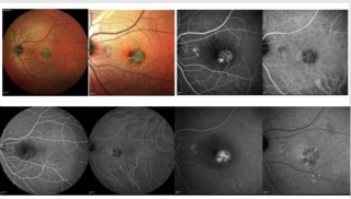 MCP and ICG are key in diagnosing and managing PCV. Spectralis enhances accuracy with detailed, layer-specific imaging of retina and choroid, ensuring better diagnosis, monitoring, and treatment outcomes.
Dr. Ashraya Nayaka, The Eye Foundation,