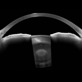 This Nuclear Sclerotic Cataract in the form of an ‘eye’ in the centre of the lens, was beautifully imaged with the Anterion.
.
Image Courtesy: Dr. Prasanna Ramesh,
 Mahatma Eye Hospital, 
Trichy.