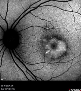 30°BAF image of VMD(vitelliform macular dystrophy).
Mrs. Susmita Ghosh

