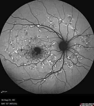 Autofluorescence image shows Fundus Flavimaculatous with foveal hypoautofluorescence and scattered hyperautofluorescent dots extending to the mid-periphery in both eyes.
Male, 45 years
Mr. Sayantan Sengupta, Sankara Nethralaya, Kolkata
