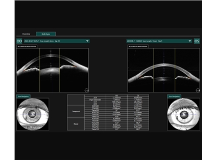 16mm full corneal analysis