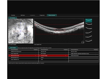 AI retina anslysis