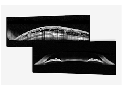 Anterior Segment Module
