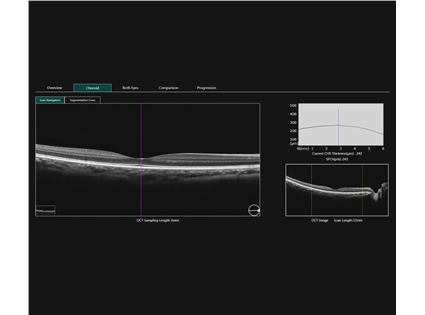 Automatic choroidal thickness analysis
