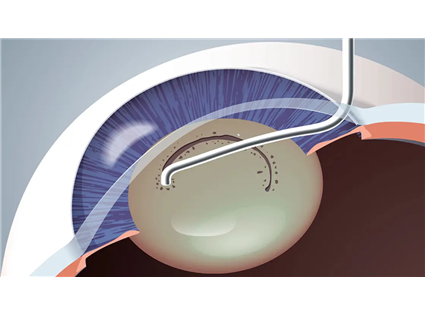 Bipolar Capsulotomy