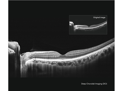 Deep Choroidal Imaging (DCI) mode