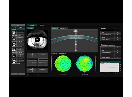 Epithelial thickness mapping