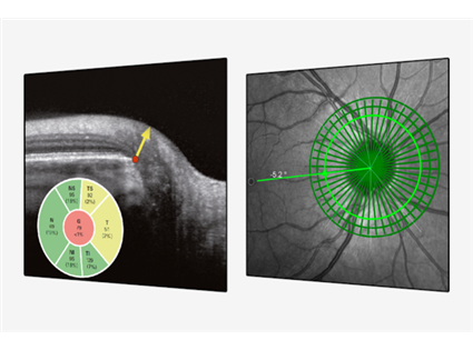 Glaucoma Module Premium Edition