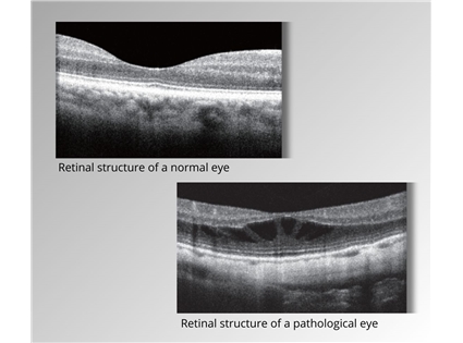 More information for retina condition