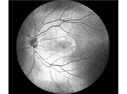 Real-time SLO with eye tracking