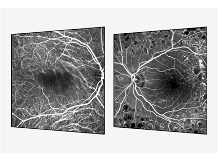 Scanning Laser Angiography