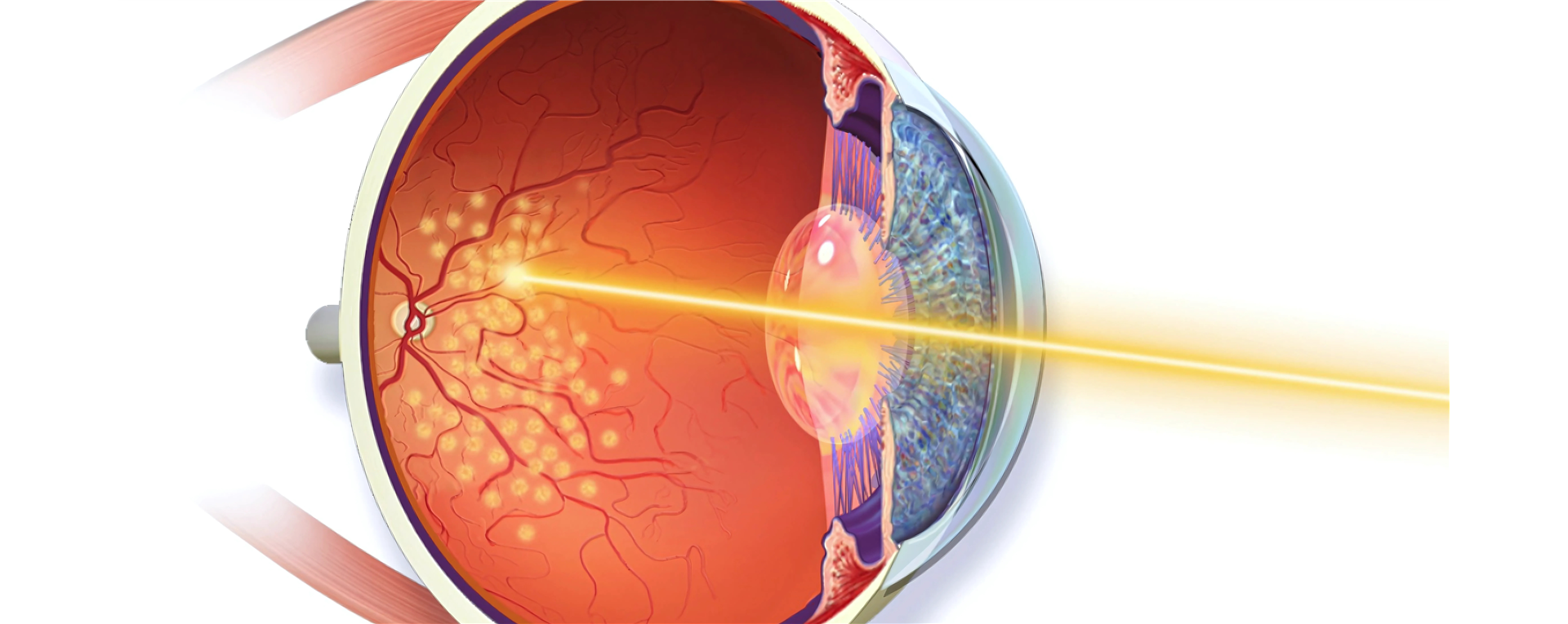 Laser Treatment Systems