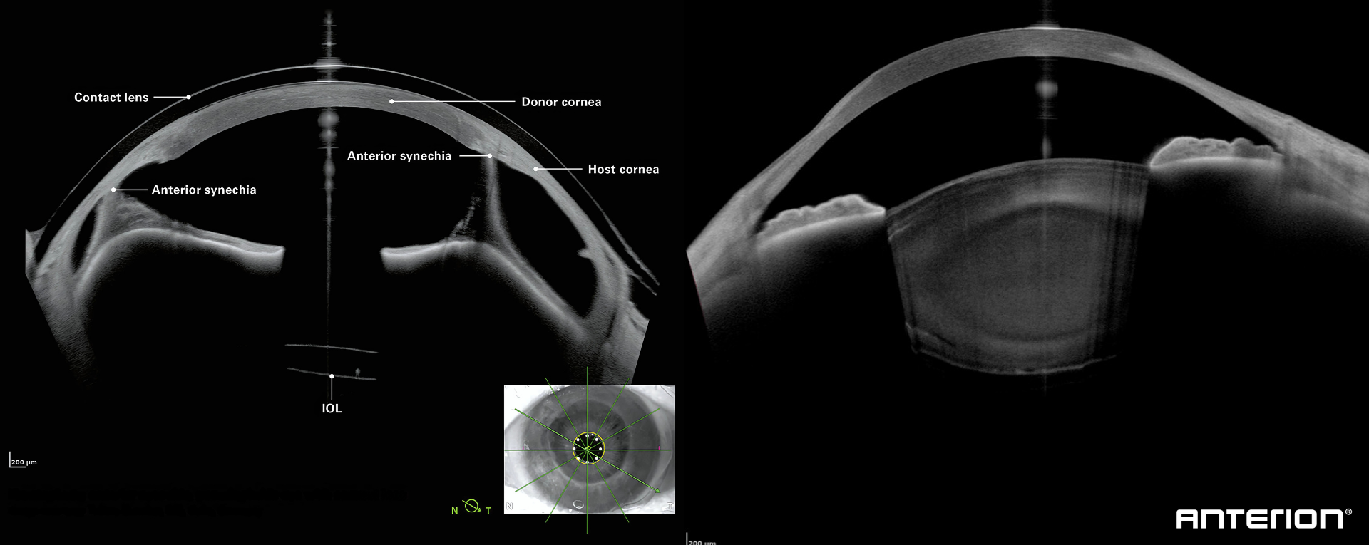 Corneal Imaging