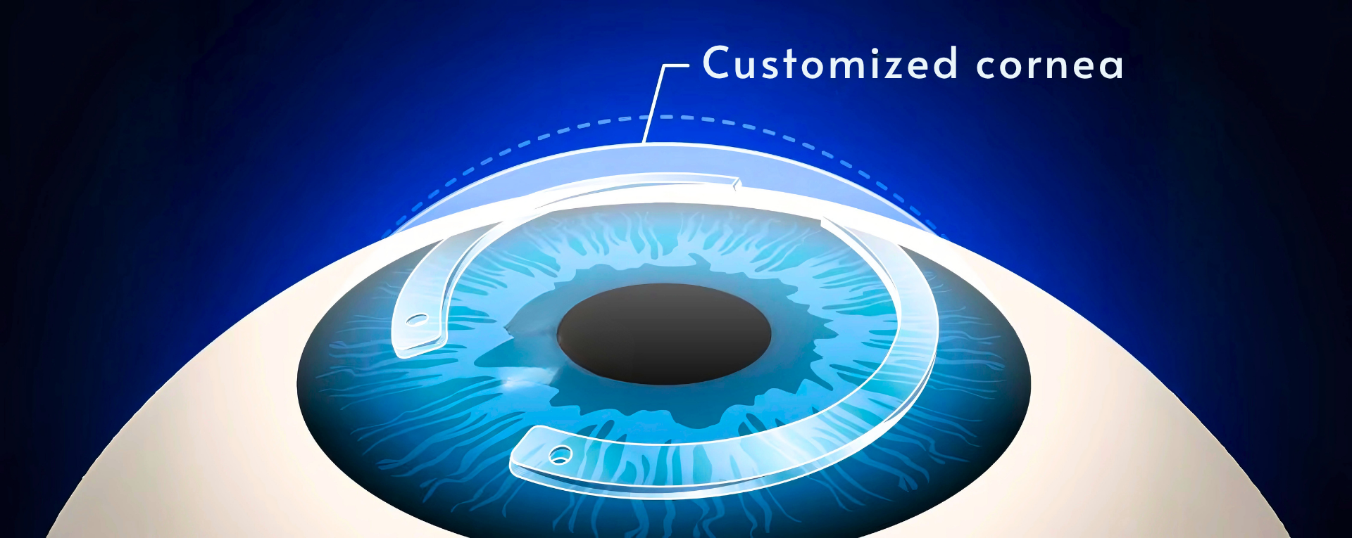 Refractive & Therapeutic Systems