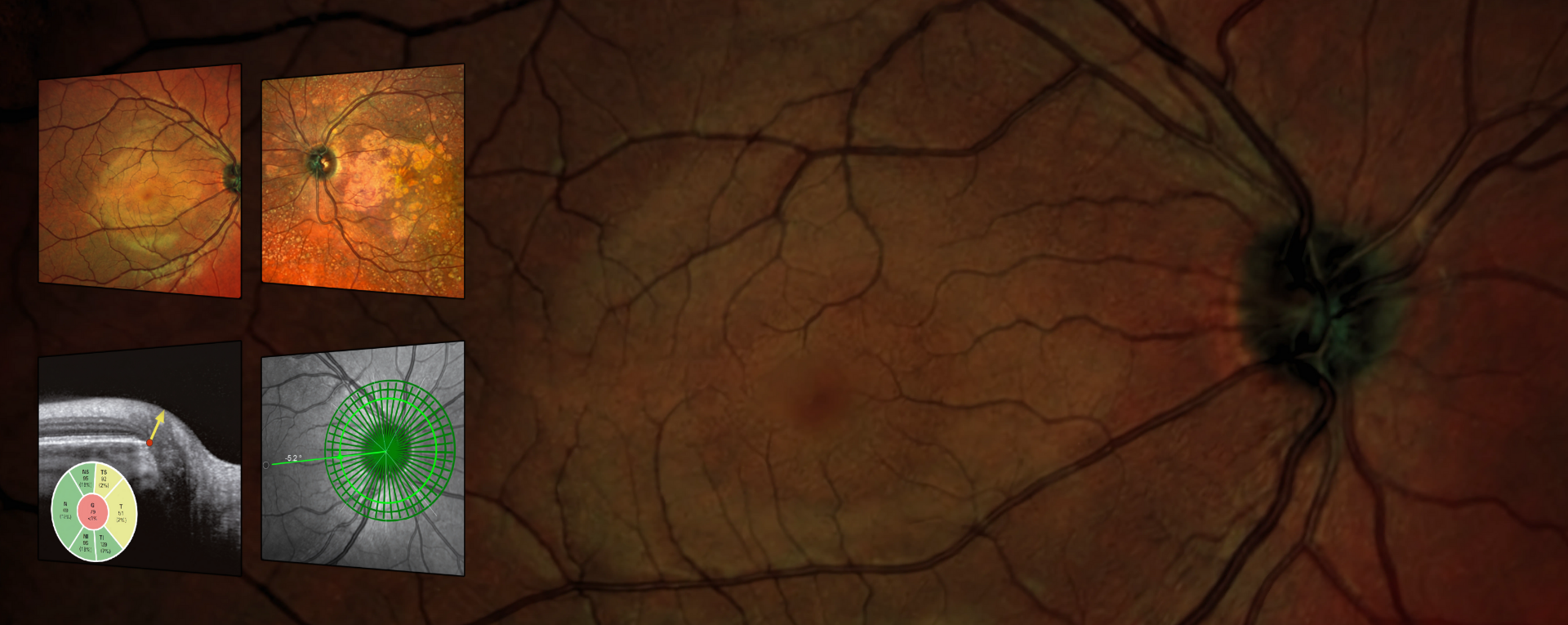 Retinal Imaging