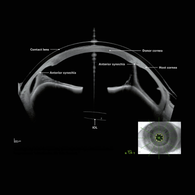 Corneal Imaging