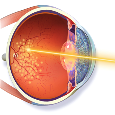 Laser Treatment Systems