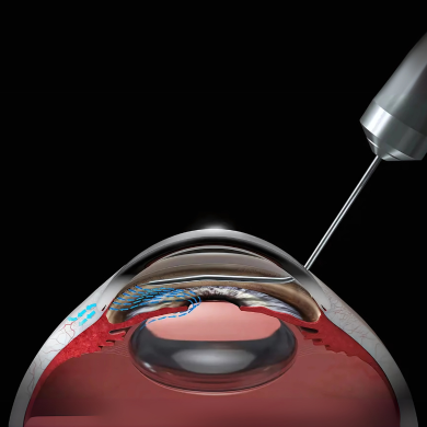 Phacoemulsification & Vitrectomy Systems