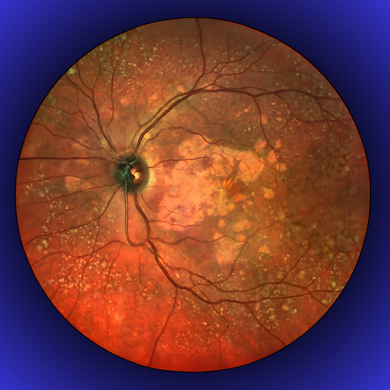 Retinal Imaging